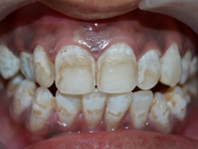 cosmetic dentistryafter2